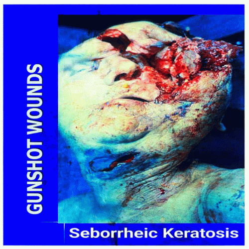 Seborrheic Keratosis : Gunshot Wounds